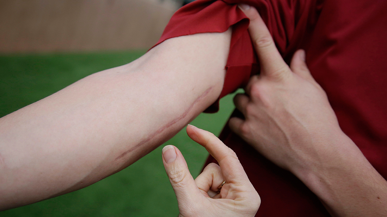 In this Thursday, Jan. 21, 2016, photo, Cal Quantrill shows a scars on his elbow from Tommy John surgery during a team workout in Stanford, Calif. (Marcio Jose Sanchez/AP)
