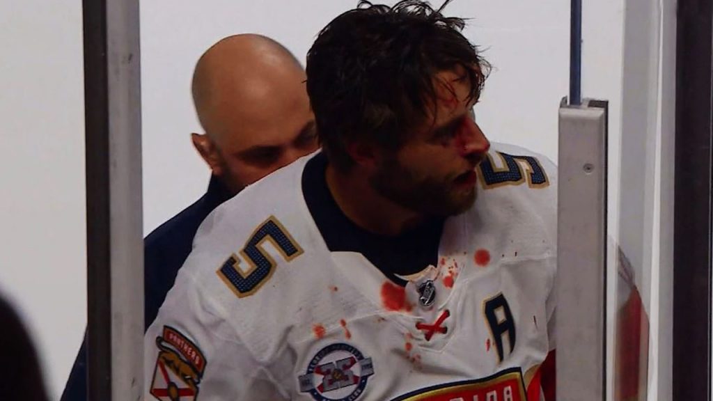 Aaron Ekblad Bleeding After Punch From Tie Domi Max Domis Sucker Offers Bad First Impression With Cana Ns Sportsnet Aaron Ekblad Bleeding After Punch From Tie Domi Max Domis Sucker Offers Bad First Impression With Cana Ns Sportsnet